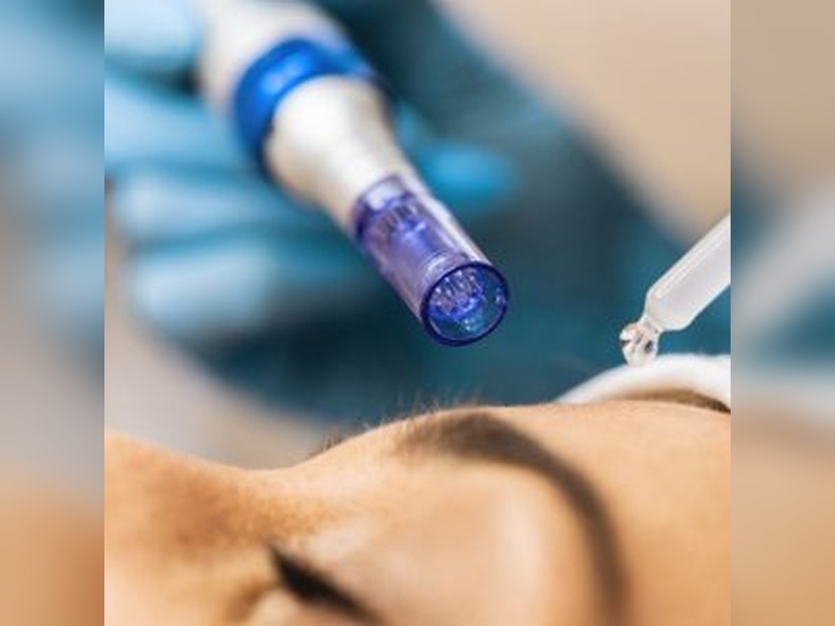 Dermapen  en KOKÖ CLINICS Murcia